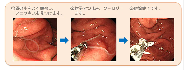 アニサキスの駆除