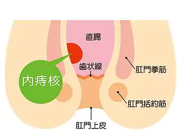 いぼ痔(内痔核)