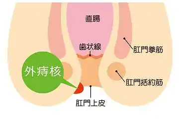 いぼ痔(外痔核)