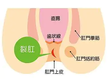 切れ痔(裂孔)