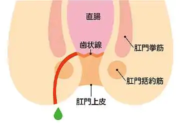 痔ろう（穴痔）