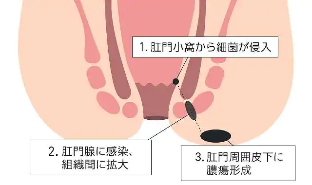 肛門周囲膿瘍とは