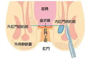 側方皮下内括約筋切開術（LSIS）