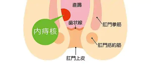 いぼ痔(内痔核)