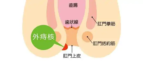 いぼ痔(外痔核)