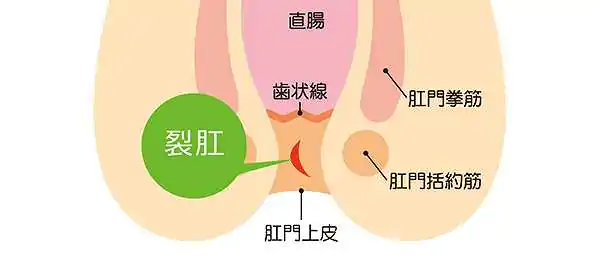 切れ痔(裂孔)