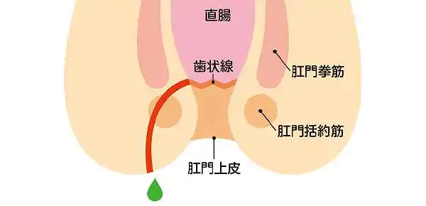 痔ろう（穴痔）