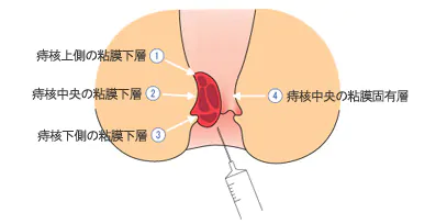 ジオン注射（ALTA療法）